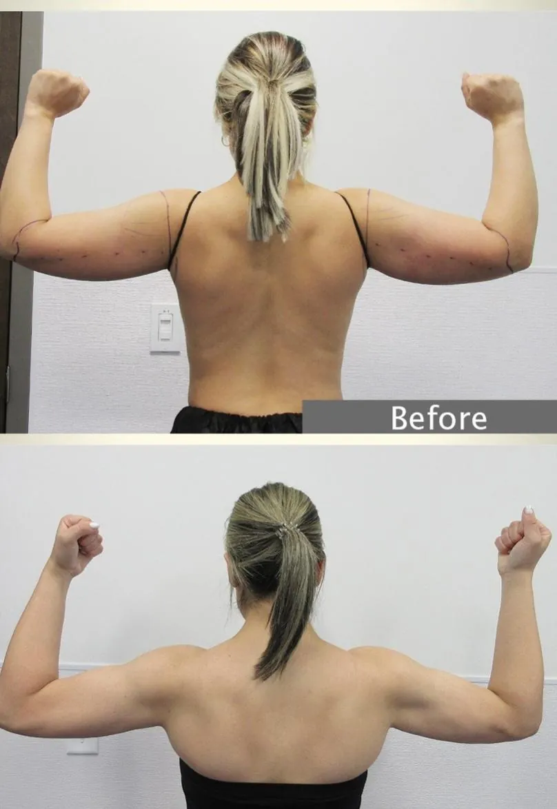 Lipœdème des bras – avant / après liposuccion WAL, photo 3